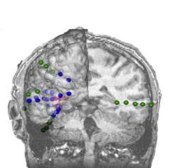 MRI