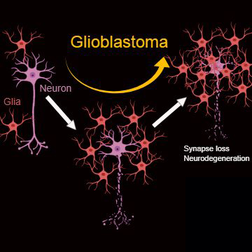 Glioblastoma